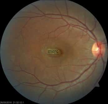 Fundus photograph showing CNVM (choroidal neovascular membrane) after wet ARMD treatment