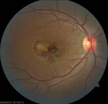 Fundus photograph showing CNVM (choroidal neovascular membrane) before wet ARMD treatment