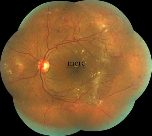 Fundus photograph showing diabetic retinopathy before treatment