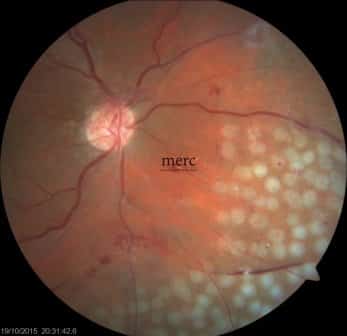 Fundus photograph showing the retina after diabetic retinopathy laser treatment