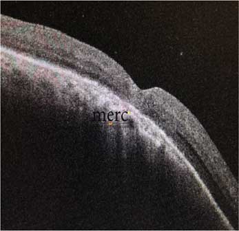 Macular hole closed after surgery