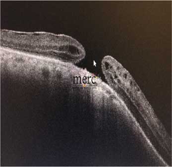 Macular hole before surgery