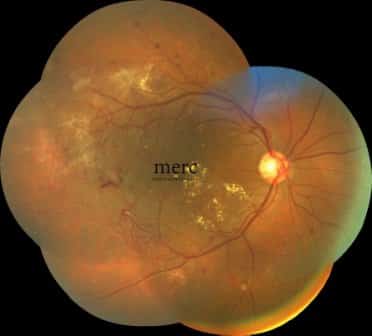 Medical retina conditions treated at Mumbai Eye Retina Clinic