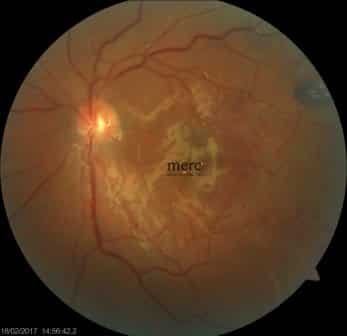 Retinal surgery — after treatment