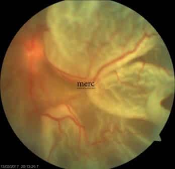 Retinal surgery — before treatment