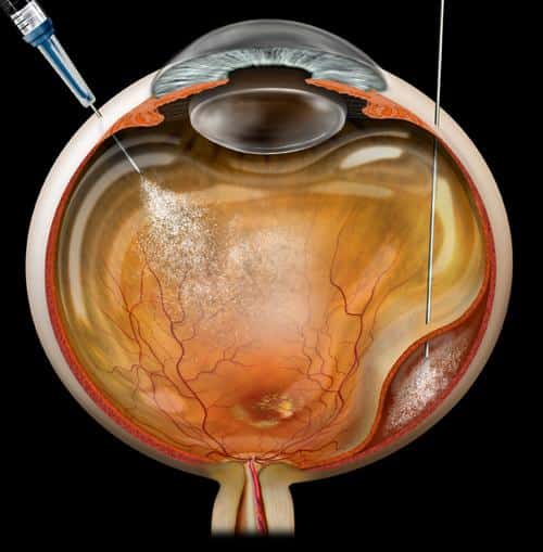 Intravitreal retinal injection procedure at Mumbai Eye Retina Clinic